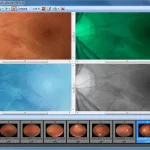 screenshot image of Acuitas activEHR 2.0 EMR Software retinal image comparison, showing fundus visuals in four filter modes and micro zooming.