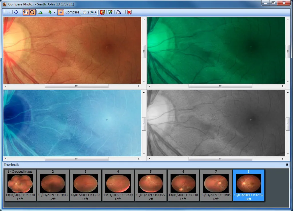 screenshot image of Acuitas activEHR 2.0 EMR Software retinal image comparison, showing fundus visuals in four filter modes and micro zooming.