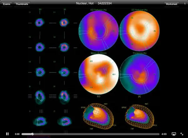UltraLinq EHR software interface showing nuclear cardiac scan with a 3D view of the heart.